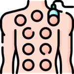 cupping 4